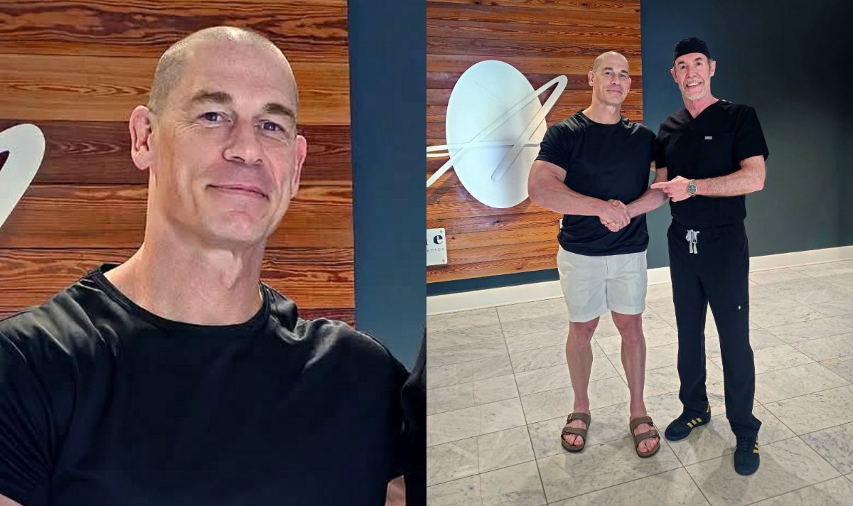 John Cena goes completely bald for second hair transplant John Cena shared a shocking new photo after undergoing a second FUE hair transplant